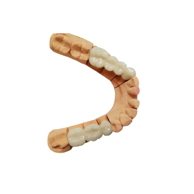 Coroa dental PFM de alta qualidade Aparência realista Cor estável Não é fácil de usar