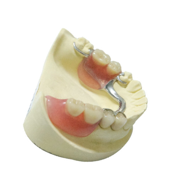 Produtos dentais do laboratório da restauração parcial removível de aço da dentadura das dentaduras