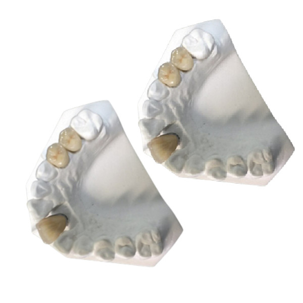 Condição nova da cor dental de grande resistência do ouro amarelo da ponte da porcelana