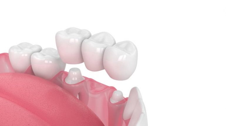 Força da mordida da estabilidade da aparência realística dental de grande resistência da ponte da coroa boa