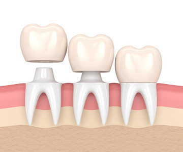 Cor estável da cor de Porcelai CrownRealistic não fácil quebrar a porcelana