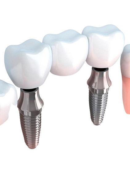 Pontes realísticas da aparência e cor natural da estabilidade forte dental das coroas