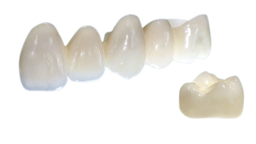 As coroas da porcelana são bonitas na forma vivo na cor e forte na estabilidade